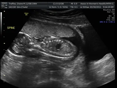 Spine of Baby Traffas